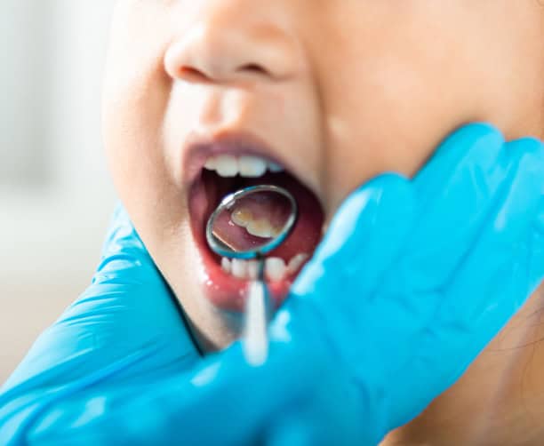 Dentist Examining Child Molar With Dental Mirror